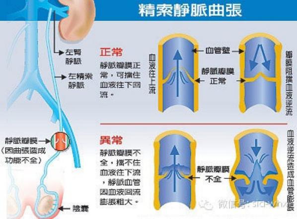 關(guān)于2021年征兵精索靜脈曲張標準的探討，2021年征兵精索靜脈曲張標準深度解析